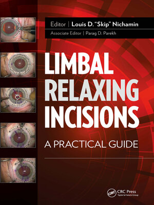 cover image of Limbal Relaxing Incisions